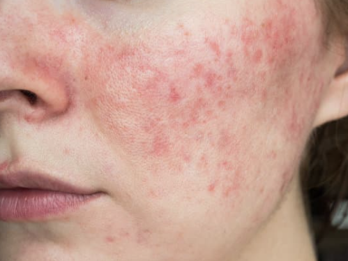 rosacea